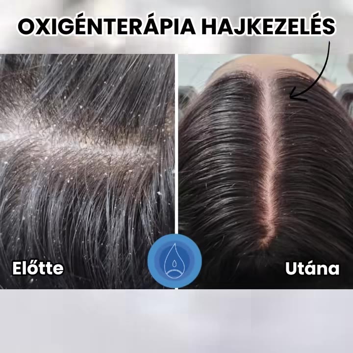 Oxigénterápia hajkezelés előtte és utána: korpás, zsíros fejbőr a kezelés előtt, tiszta és egészséges a kezelés után
